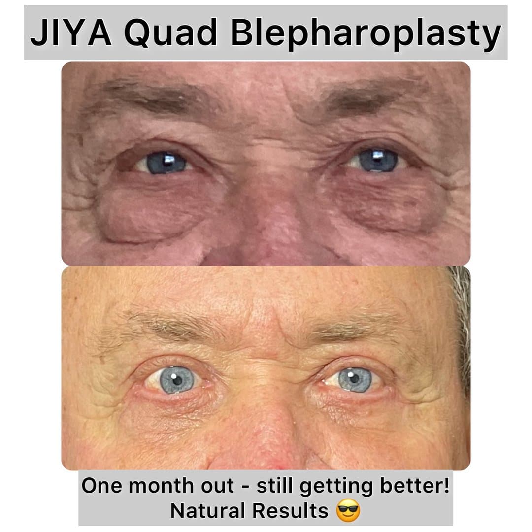 JIYA before and after result 5