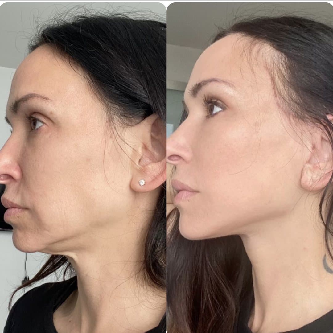 JIYA before and after result 6