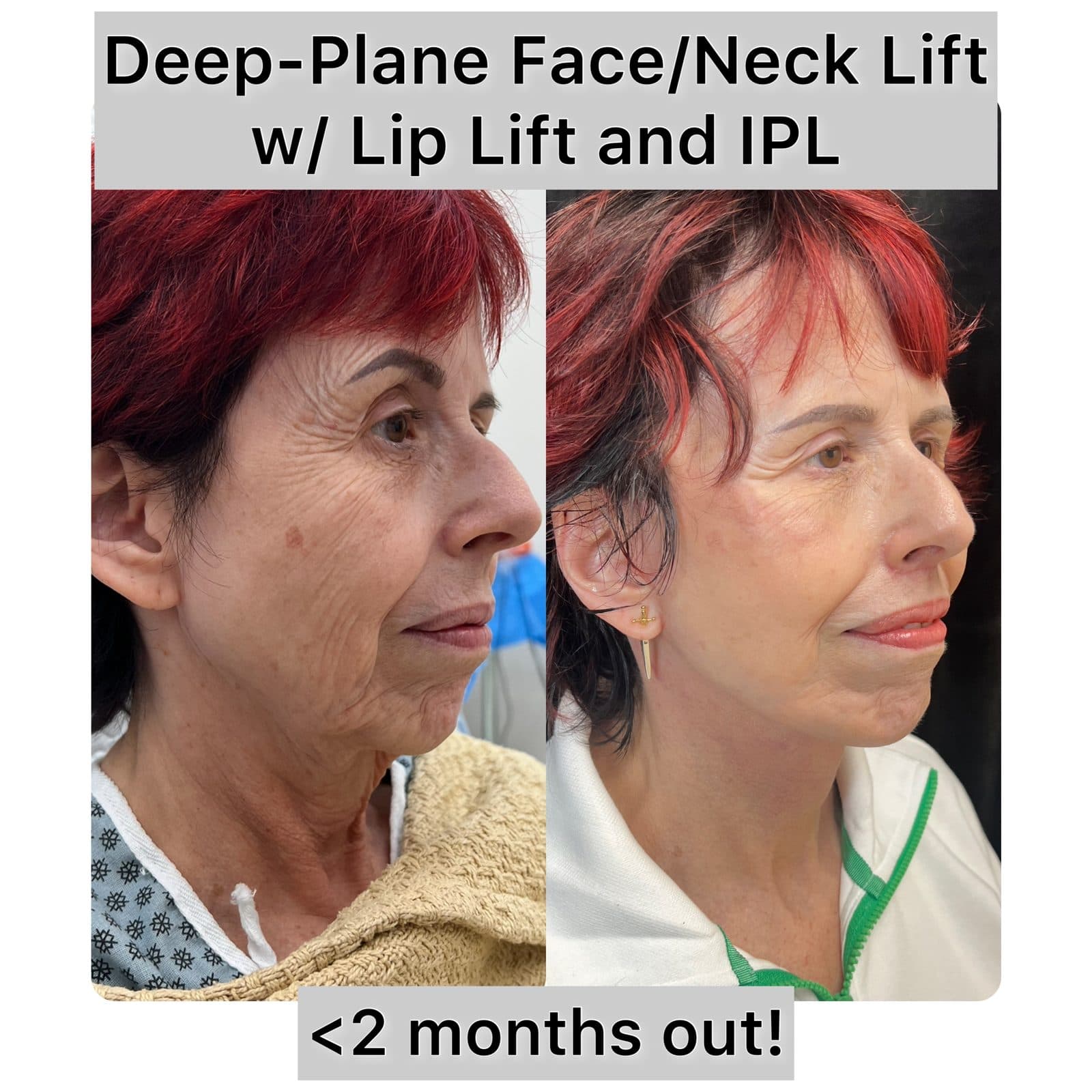 Deep Plane Face & Neck Lift before and after