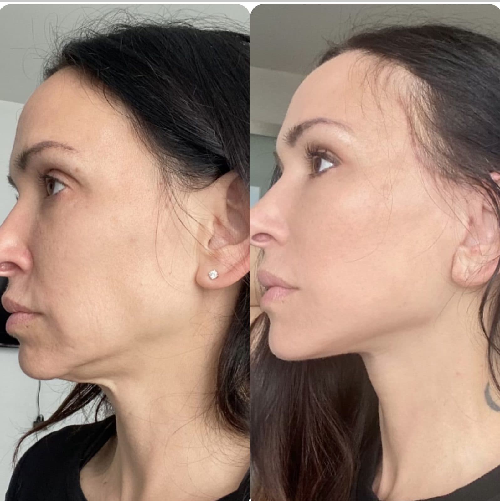 Face & Neck Lift before and after