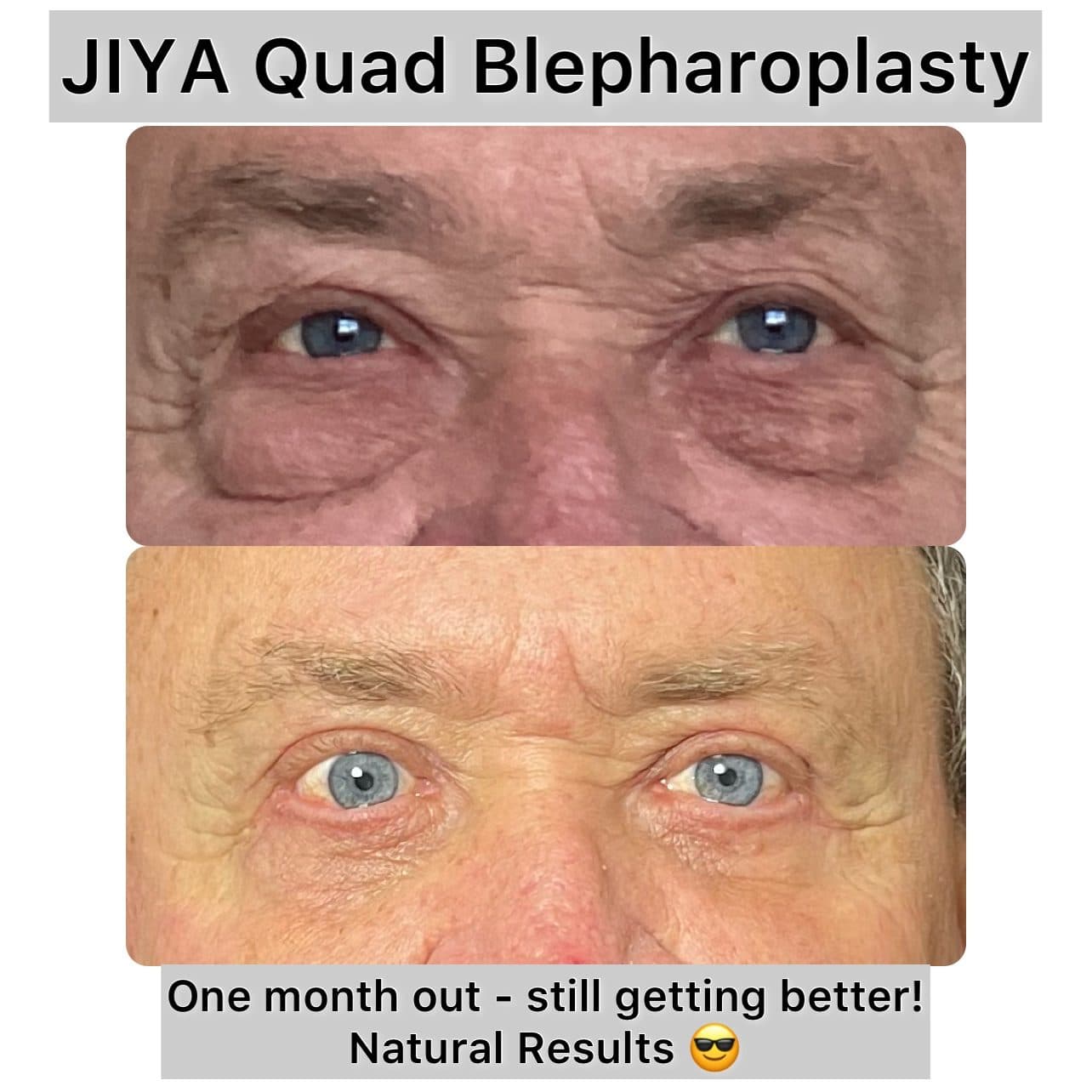 Quad Blepharoplasty before and after